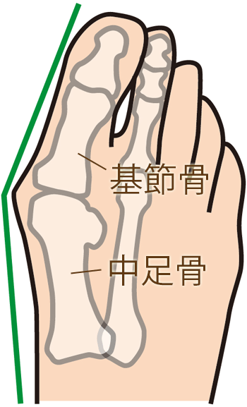 外反母趾の骨格の変形　中足骨（第一中足骨）と基節骨