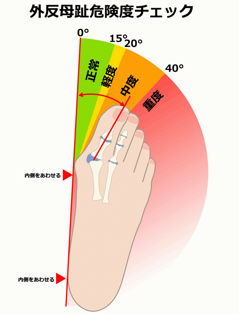 外反母趾 危険度チェック 母指の角度