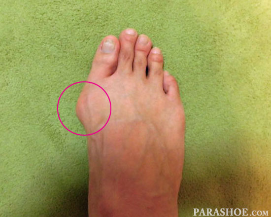 外反母趾の足（素足）の写真
