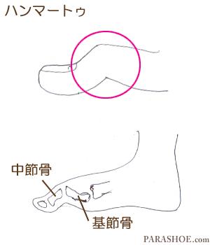 ハンマートゥ・屈趾症（くっししょう）のイラストと、骨格図