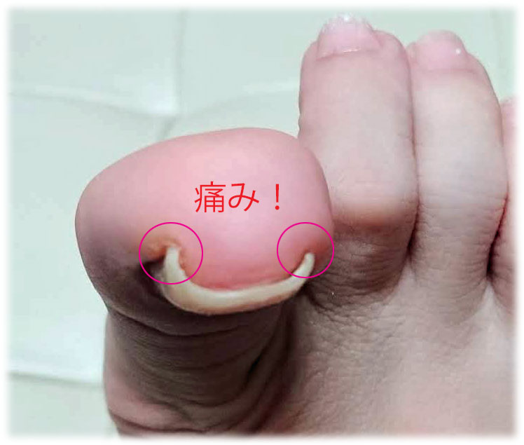 巻き爪（まきずめ）になった足の親指・第一趾（母趾）