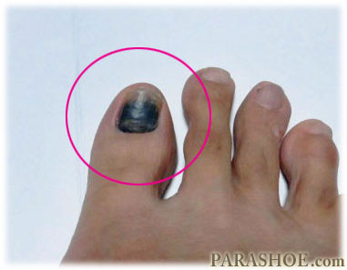 爪下血腫（そうかけっしゅ）を発症した足の親指（母趾）