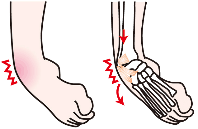 足首の内反捻挫と足の骨格