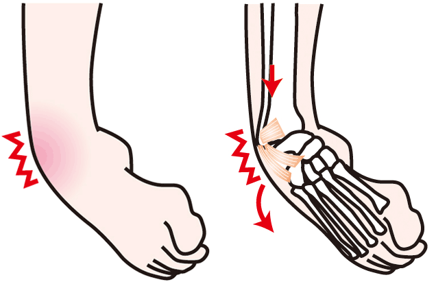 くるぶし 片方 腫れ