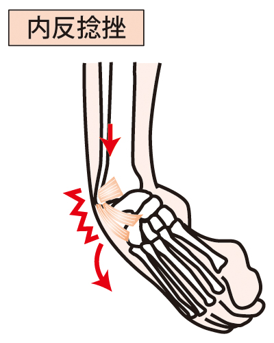 捻挫 足首捻挫 の原因と応急処置 包帯による固定 巻き方 セルフケア テーピング方法 靴専門通販サイト 靴のパラダイス